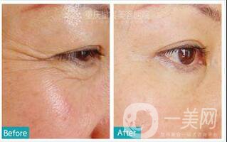 *多少錢一針,*價(jià)格