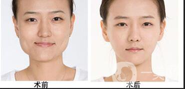 磨腮削骨多少錢