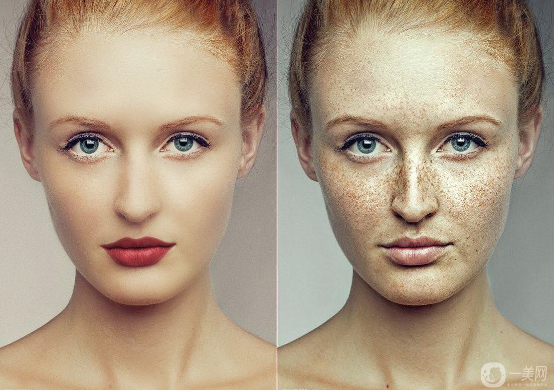 祛斑價(jià)格是多少 祛斑的方法有哪些