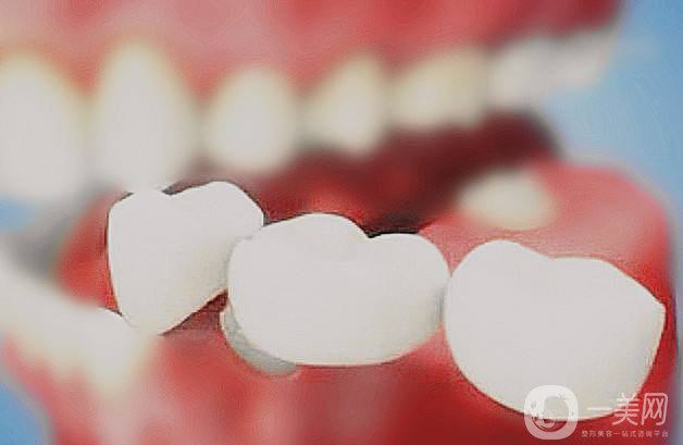 仿生美容冠多少錢 仿生美容冠的*果怎么樣