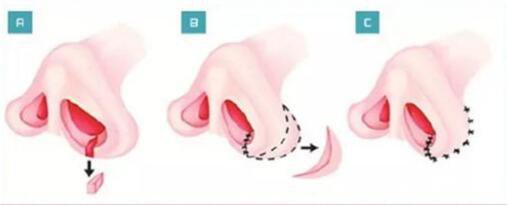 鼻翼縮小整形價格 鼻翼縮小多久恢復