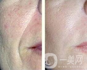 熱瑪吉除皺*果,熱瑪吉除皺風險