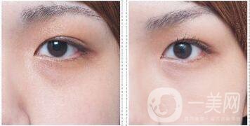 玻尿酸去黑眼圈貴嗎,玻尿酸去黑眼圈多少錢