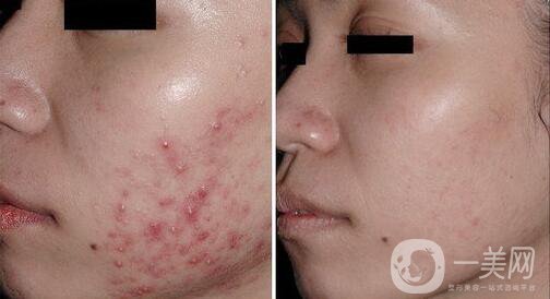 果酸換膚多少錢,果酸換膚價格