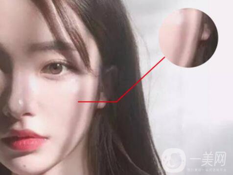 磨顴骨*果怎么樣 有什么風(fēng)險(xiǎn)嗎？