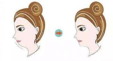 硅膠墊下巴貴嗎 硅膠墊下巴好不好