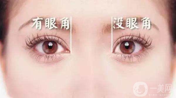 開眼角手術(shù)圖怎么樣 開眼角手術(shù)價格
