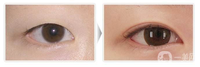 開眼角手術(shù)圖怎么樣 開眼角手術(shù)價格