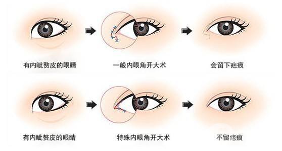 開眼角前后照片分享 開眼角好不好
