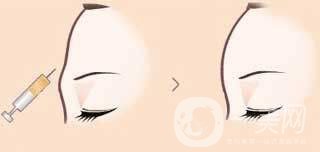 自體脂肪豐額頭貴嗎 影響豐額頭價格的因素