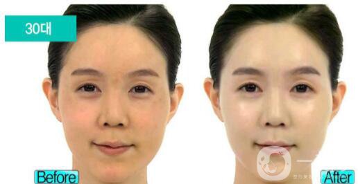 激光祛斑價(jià)格表 激光祛斑有副作用嗎