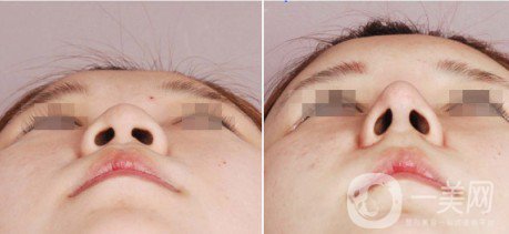 假體隆鼻整型術怎么樣 什么人不適合做假體隆鼻？