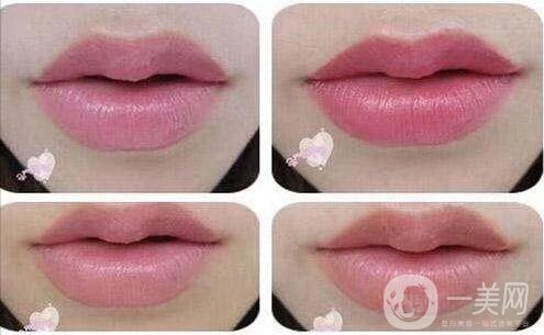 玻尿酸豐唇后會腫嗎 *果怎么樣？