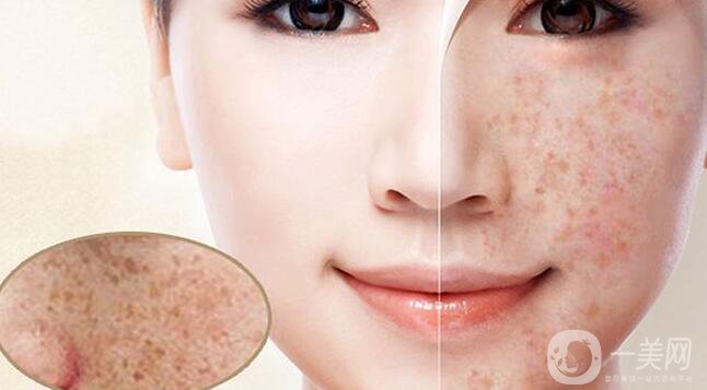 色素沉著如何處理 怎么去除？