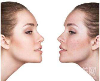 IPL的*果能持續(xù)多久 IPL的作用是什么