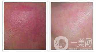 怎樣消除紅血絲 紅血絲如何調(diào)節(jié)