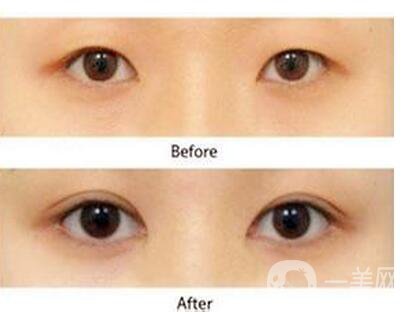 三點定位割雙眼皮圖片,三點定位割雙眼皮缺陷