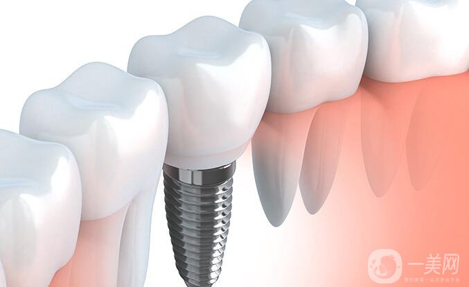 種植牙和鑲牙哪個更好