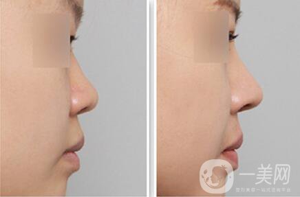 做個鼻翼縮一次多少錢