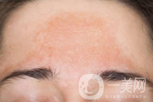 黃褐斑怎么調(diào)節(jié)**?