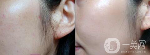 點(diǎn)痣多少錢一顆 點(diǎn)痣后要注意什么