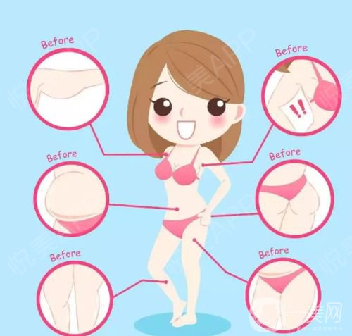 沃斯堡冰雕如何減少頑固脂肪 *果好不好?