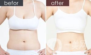 小腹肌成形術(shù)風(fēng)險有多大 小腹肌成形術(shù)的恢復(fù)時間