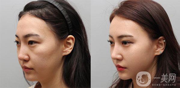 王旭明隆鼻案例 王旭明隆鼻怎么樣