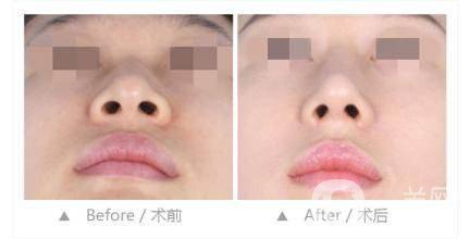 鼻翼怎么變小竅門 鼻翼變小的方法