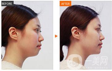 隆鼻失敗是免費修復(fù)嗎 隆鼻失敗有后遺癥嗎