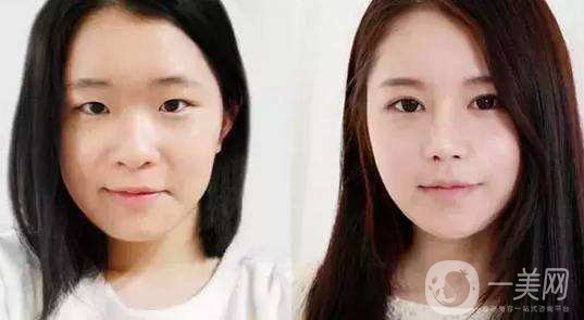 什么眼皮不能割雙眼皮手術 割雙眼皮注意事項