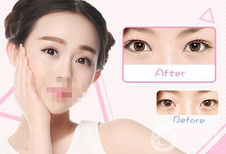 什么眼皮不能割雙眼皮手術 割雙眼皮注意事項