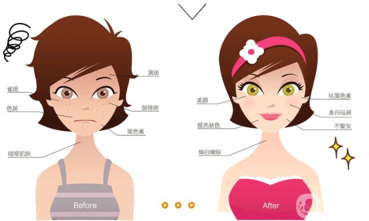 激光祛斑的價(jià)格 激光祛斑的*果好不好