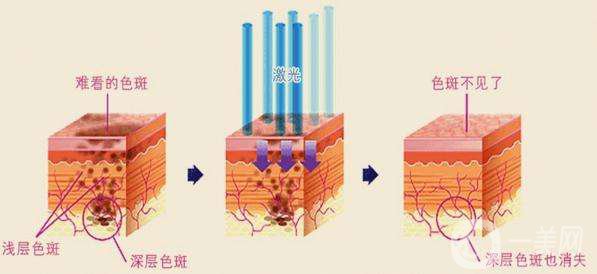 激光祛斑的價(jià)格 激光祛斑的*果好不好
