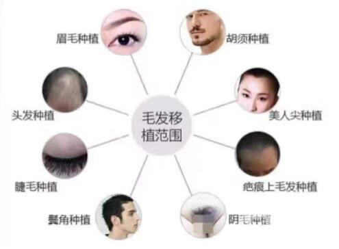 毛囊可以移植別人的嗎 毛囊移植*嗎