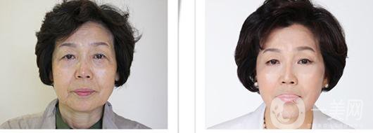 整容手術(shù)要多久時間 整容手術(shù)風(fēng)險有多大