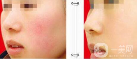 光子嫩膚的原理