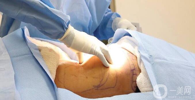 抽脂適宜人群,抽脂注意事項(xiàng)