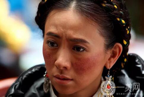 臉上長紅血絲怎么辦?去紅血絲攻略親測*