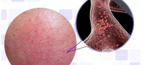 臉上長紅血絲怎么辦?去紅血絲攻略親測*