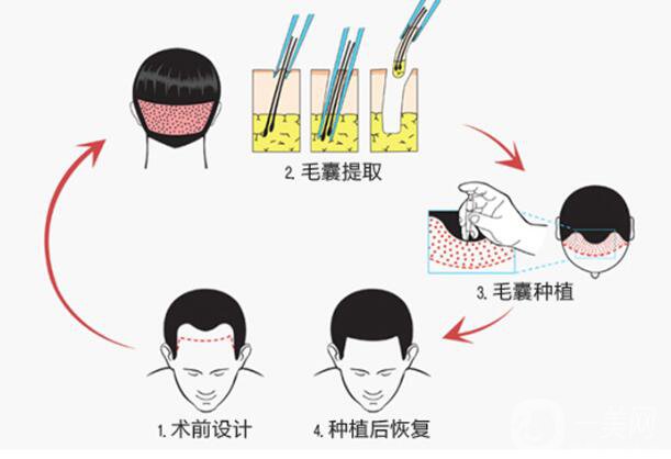 植發(fā)的*果是*性的嗎 它的原理是什么？