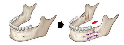 雙頜前突是什么 凸嘴不好看該怎么辦？
