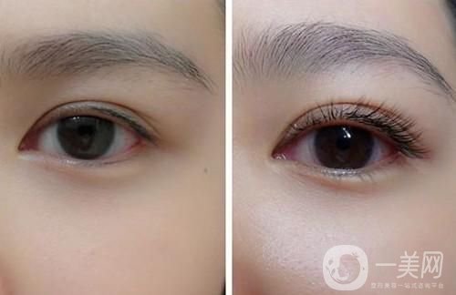 種睫毛多少錢(qián) 種睫毛手術(shù)時(shí)間是多久
