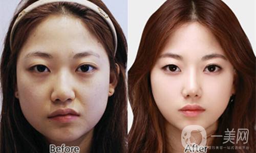 三個驚人的小竅門 可以使整形手術(shù)恢復(fù)得更快