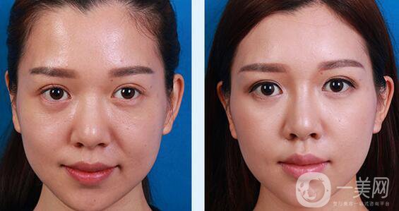 埋線面部提升多久恢復(fù) 術(shù)后如何護(hù)理？