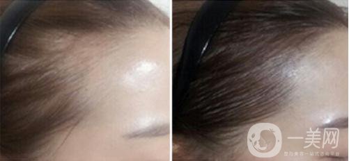 發(fā)際線做了能保持多久時(shí)間 發(fā)際線有危害嗎