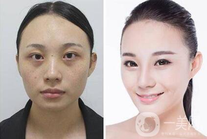 隆鼻整容有哪些方法 隆鼻后注意事項(xiàng)