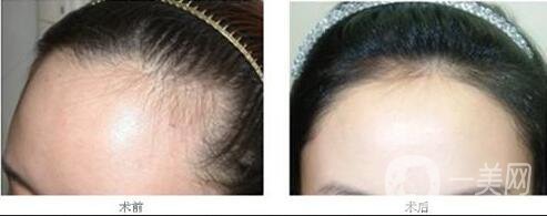 發(fā)際線種植手術(shù)價(jià)格,發(fā)際線種植術(shù)后護(hù)理