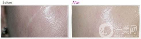 祛疤手術(shù)好還是激光好 恢復(fù)時(shí)間分別是多久