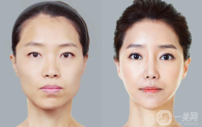 什么是臉頰美容手術 美容*果怎么樣